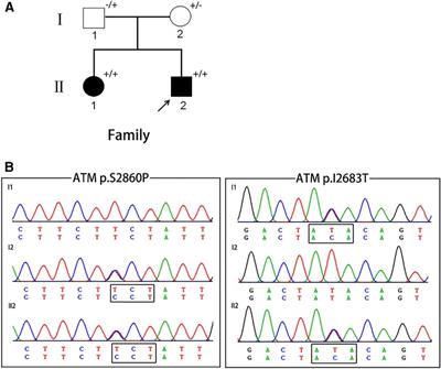 Two novel heterozygote mutations of ATM in a Chinese family with dystonia-dominant ataxia telangiectasia and literature review